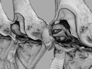 Osteoarthritis stages 3D 3D Model