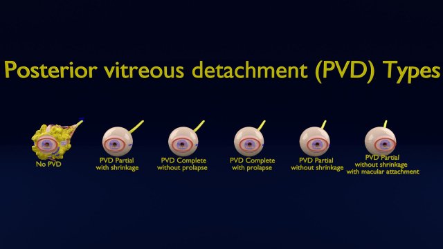 Posterior vitreous detachment types eye Modelo 3D .c4d .max .obj .3ds .fbx .stl .blend 