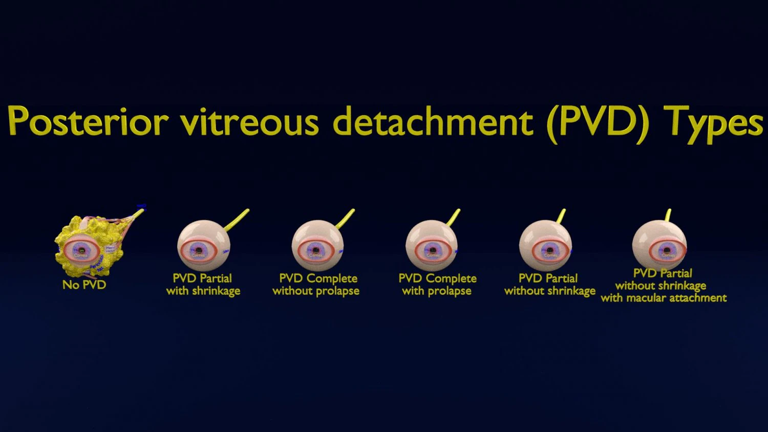 Posterior vitreous detachment types eye 3D Model .c4d .max .obj .3ds .fbx .stl .blend 
