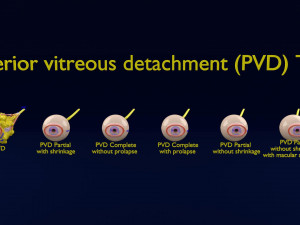 Posterior vitreous detachment types eye 3D Model
