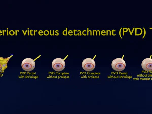 Typy odwarstwienia ciała szklistego tylnego oka Model 3D