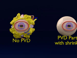 Posterior vitreous detachment types eye 3D Model