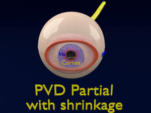 Posterior vitreous detachment types eye Modelo 3D