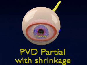 Posterior vitreous detachment types eye 3D Model
