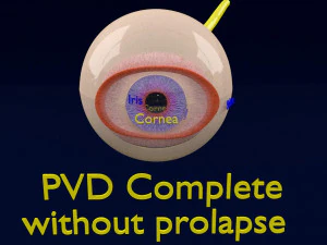 Posterior vitreous detachment types eye 3D Model