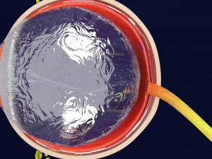 Posterior vitreous detachment types eye 3D Model