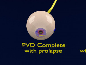 Posterior vitreous detachment types eye Modelo 3D