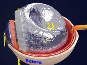 Posterior vitreous detachment types eye 3D Model