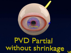 Posterior vitreous detachment types eye Modelo 3D