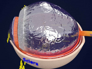 Posterior vitreous detachment types eye Modelo 3D