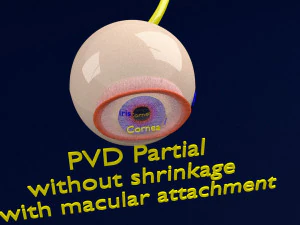 Posterior vitreous detachment types eye 3D Model