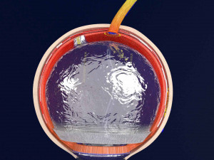 Posterior vitreous detachment types eye Modelo 3D
