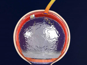 Posterior vitreous detachment types eye 3D Model