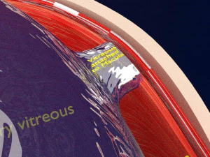 Posterior vitreous detachment types eye 3D Model