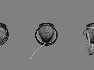 Posterior vitreous detachment types eye 3D Model