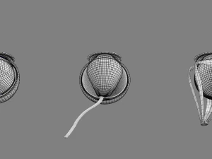 Posterior vitreous detachment types eye 3D Model