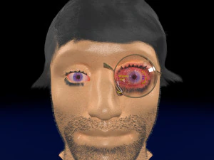 3D-Schilddr&uuml;sen-Augenerkrankung 3D Modell