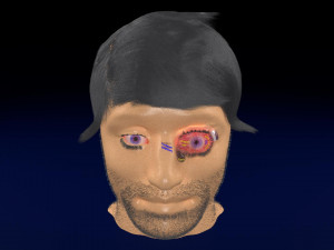 3D thyroid eye disease Model 3D