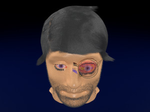 3D thyroid eye disease Model 3D
