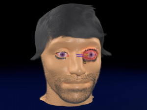 3D thyroid eye disease Model 3D