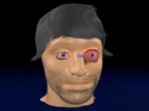 3D thyroid eye disease 3D Model
