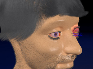 3D thyroid eye disease Model 3D