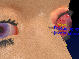 3D thyroid eye disease Model 3D