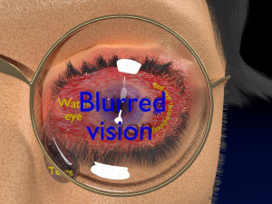 3D thyroid eye disease Model 3D