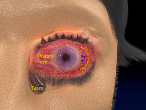 3D thyroid eye disease Model 3D