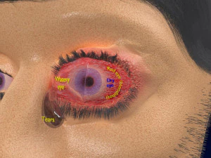 3D thyroid eye disease 3D Model