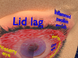 3D thyroid eye disease Model 3D