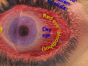 3D thyroid eye disease Model 3D