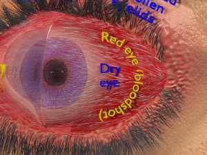 3D thyroid eye disease 3D Model