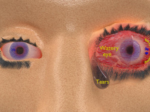 3D thyroid eye disease Model 3D
