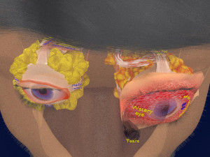 3D thyroid eye disease Model 3D
