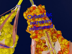 3D thyroid eye disease Model 3D