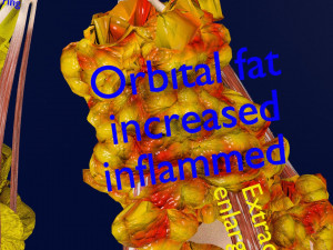 3D thyroid eye disease Model 3D