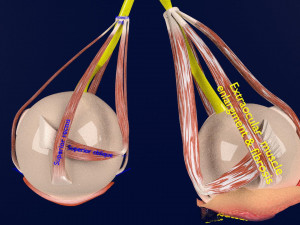 3D thyroid eye disease Model 3D