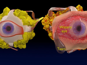 3D thyroid eye disease Model 3D