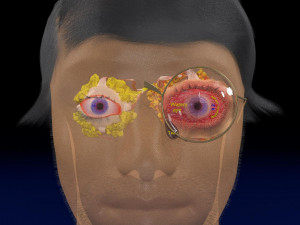 3D thyroid eye disease Model 3D