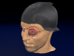 3D thyroid eye disease Model 3D