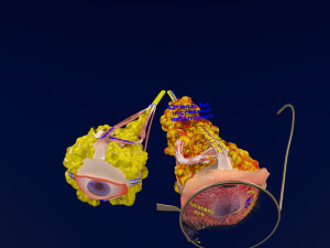 3D thyroid eye disease Model 3D