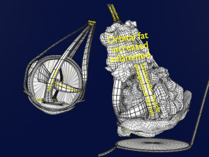 3D thyroid eye disease Model 3D