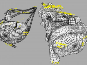 3D thyroid eye disease Model 3D