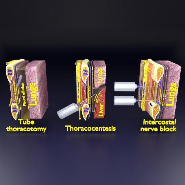 3D thoracic procedures Modelo 3D .c4d .max .obj .3ds .fbx .stl .blend 
