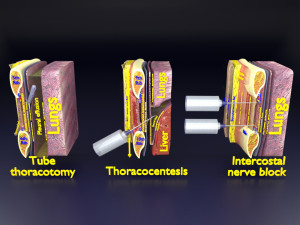 3D thoracic procedures 3D Model