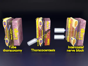 3D 흉부 시술 3D 모델