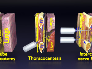3D thoracic procedures Modelo 3D