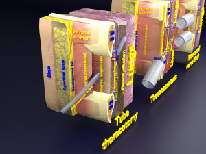3D thoracic procedures Modelo 3D
