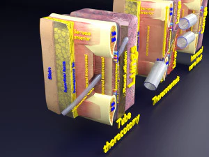 3D thoracic procedures 3D Model